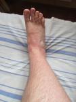 Разрастающаяся красная сыпь на ногах фото 1