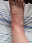 Разрастающаяся красная сыпь на ногах фото 2