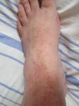 Разрастающаяся красная сыпь на ногах фото 4