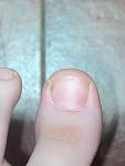 Черная точка на ногте, отек кожи возле ногтя фото 1