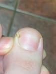 Черная точка на ногте, отек кожи возле ногтя фото 2