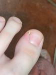 Черная точка на ногте, отек кожи возле ногтя фото 3