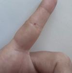 Красная точка на пальце, как кровоподтек фото 1