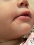 Раздражение вокруг рта у малыша фото 3