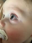 Красный глаз в 10 месяцев фото 2