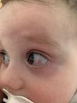 Красный глаз в 10 месяцев фото 1