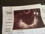 Киста яичника и внематочная беременность фото 2