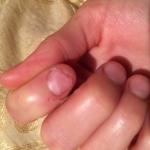 Проблема кожи и ногтей на руке фото 3