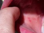 Какие аутоиммунных болезни могут давать пятна во рту? фото 3