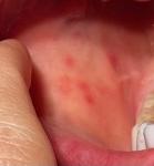 Какие аутоиммунных болезни могут давать пятна во рту? фото 2
