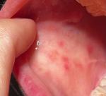 Какие аутоиммунных болезни могут давать пятна во рту? фото 1
