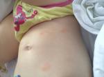 Аллергия у ребенка 1.2 год фото 1