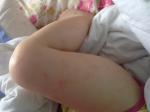 Аллергия у ребенка 1.2 год фото 3