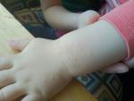 Сыпь у ребенка на руке маленькие прыщики ребенка не беспокоет фото 1