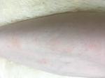 Розовые пятна на ногах (зуд) фото 1