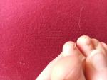 Утолщение ногтя на ноге фото 2