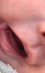 Папиллома во рту новорождённого фото 1