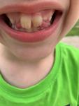 Налет на передних верхних коренных зубах у ребенка фото 1