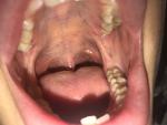 Красные пятна на небе от лечения зуба фото 1
