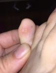 Болезненное воспаление между пальцев ноги фото 1