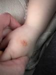 Появилось шероховатое пятно на руке у ребенка фото 1