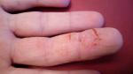 Экзема среднего пальца на правой руке с трещинами болезнеными фото 1