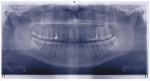 Ортопантомография - тень по нижней стенке пазухи фото 1