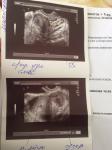 Леймиома тела матки при беременности фото 1