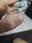 Меланома или невус ногтя фото 1