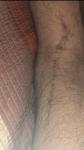 Красно-фиолетовые пятна на ноге фото 2