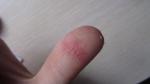 Болит красный палец фото 1