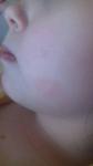 Розовые пятна на щеках у ребенка фото 3