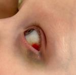 Травма глаза у ребёнка фото 1
