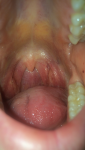 Увеличены лимфоузлы без боли в горле фото 2