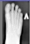 Перелом пятой плюсневой кости левой ноги фото 1