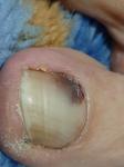 Коричневое пятно на ногте большого пальца ноги фото 1