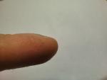 Отслоение ногтя и водянистые точки около ногтей фото 3