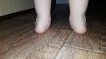 Вальгусная деформация стопы у ребенка фото 1