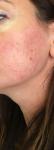 Сыпь и прыщи на щеках 7 месяцев не проходят фото 1