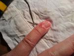 Воспаление кожи возле ногтевой пластины на палце руки фото 1