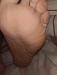 Белые точки на ногах у диабетика фото 2