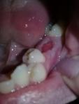 Нормально ли выглядит рана после удаления зуба? фото 1