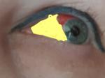 Глаз после операции по замене хрусталика фото 1