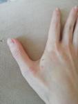 Сыпь на руке в течение 5 дней фото 4