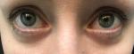 Красные сосуды в глазах и напряжение (8 месяцев) фото 2