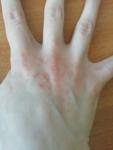 Сыпь на руке в течение 5 дней фото 5