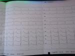 Расшифровка ЭКГ с нагрузкой и без фото 2