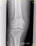 Осложнение, или неправильно проведенная операция ПКС коленного сустава фото 3