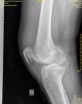 Осложнение, или неправильно проведенная операция ПКС коленного сустава фото 2