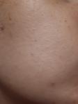 Мелкая подкожная сыпь на лице фото 2